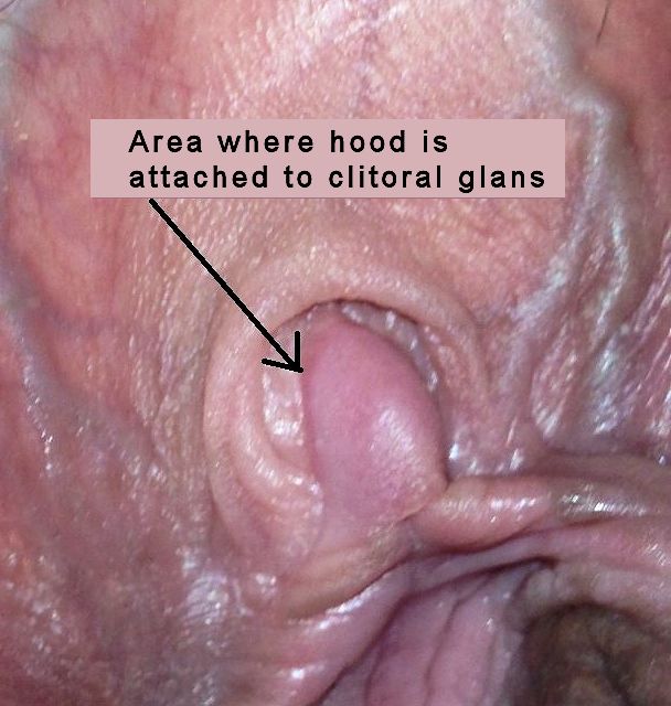 Photograph of Clitoral Adhesion