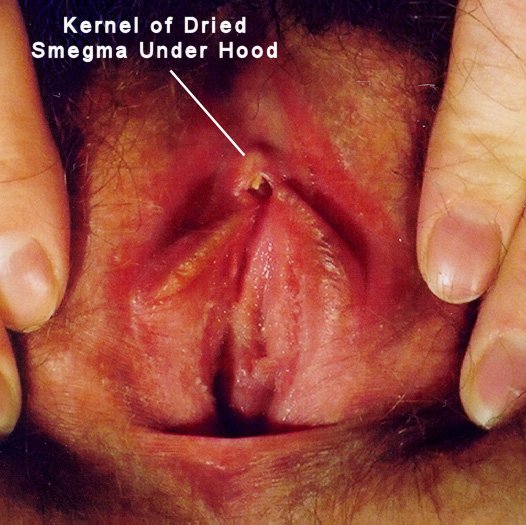 A kernel of dried smegma is visible between the clitoral glans and hood