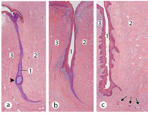 Examples of Clitoral Adhesions in Adults