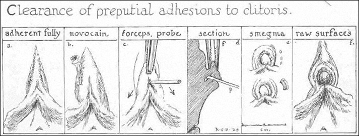 Surgical removal of clitoral adhesions with blunt probe