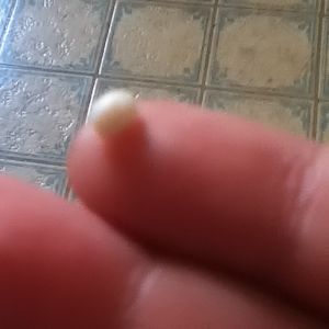 White ball of smegma from between the clitoral glands and hood